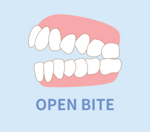 Fixing Your Bite with Orthodontics Wood orthodontics dentist in Weatherford TX Dr. Steve Wood